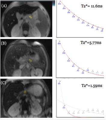 Magnetic resonance imaging T2* of the pancreas value using an online software tool and correlate with T2* value of myocardium and liver among patients with transfusion-dependent thalassemia major